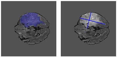 Frontiers | Weakly supervised pre-training for brain tumor segmentation using principal axis measurements of tumor burden